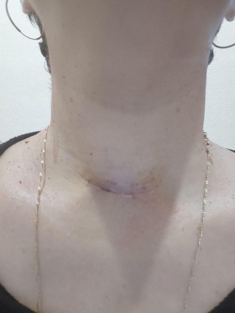 Шов після операції на щитоподібній залозі через 2 тижні